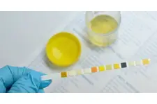 İdrarda Eritrosit Değeri Kaç Olmalı? İdrarda Eritrosit Değeri Kaç Olmalı?