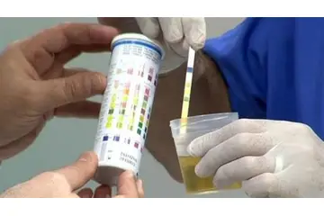 İdrar Tahlili Eritrosit Nedir?