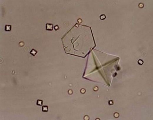 İdrarda Eritrosit Tedavisi Nasıl Olmalıdır